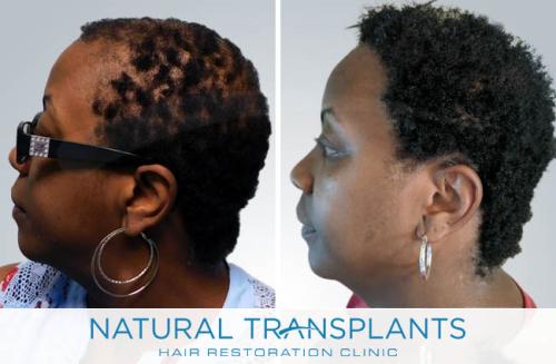 Female Hair Transplant