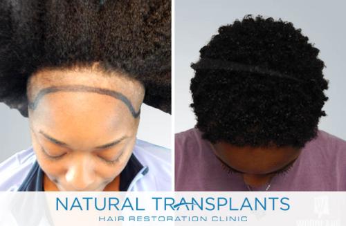 Female Hair Transplant