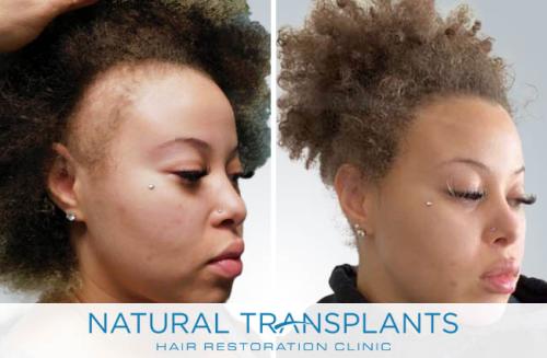 Female Hair Transplant