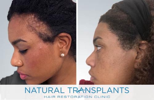 Female Hair Transplant