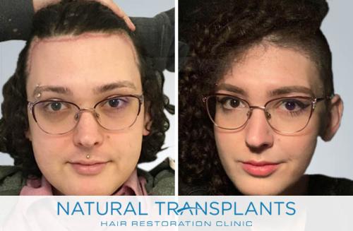 Female Hair Transplant