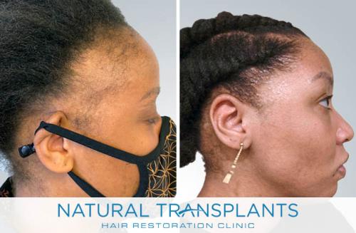 Female Hair Transplant