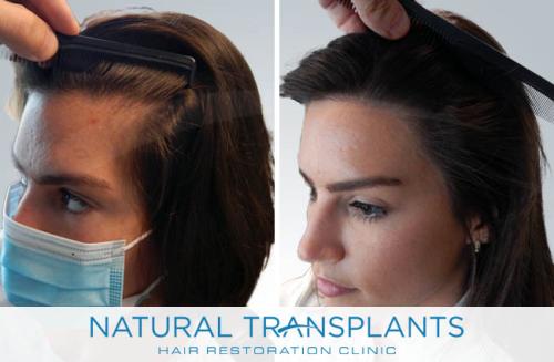 Female Hair Transplant