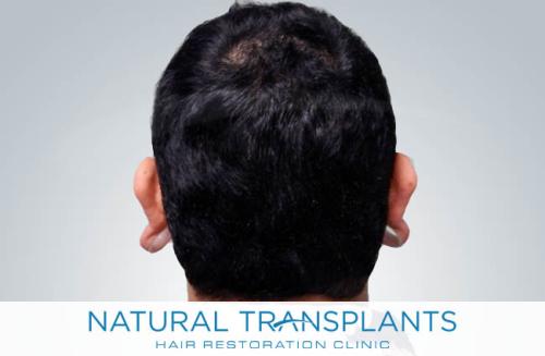 Undetectable Hair Transplant Scar