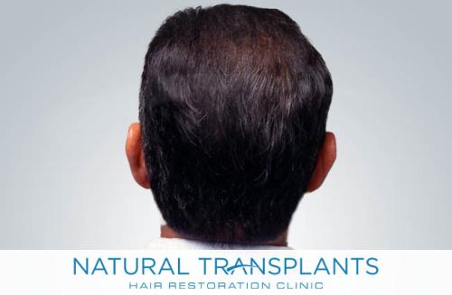 Undetectable Hair Transplant Scar