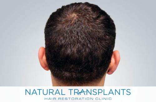 Undetectable Hair Transplant Scar