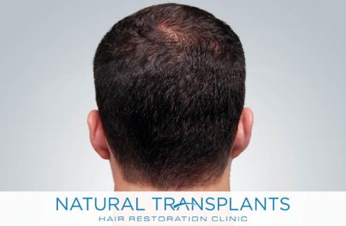 Undetectable Hair Transplant Scar