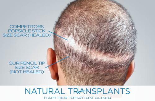 Undetectable Hair Transplant Scar