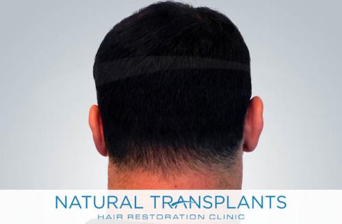 Undetectable Hair Transplant Scar