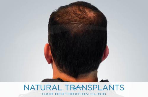 Undetectable Hair Transplant Scar