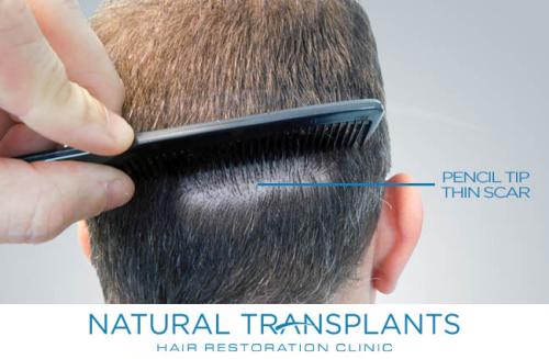 Undetectable Hair Transplant Scar