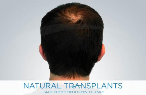 Undetectable Hair Transplant Scar