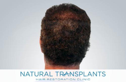 Undetectable Hair Transplant Scar