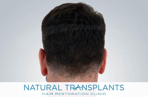 Undetectable Hair Transplant Scar