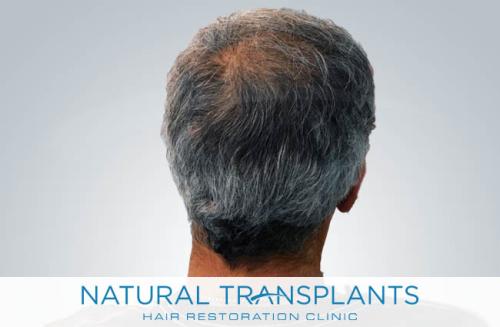 Undetectable Hair Transplant Scar