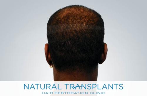 Undetectable Hair Transplant Scar