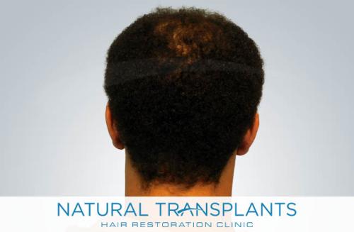 Undetectable Hair Transplant Scar