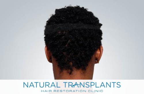 Undetectable Hair Transplant Scar