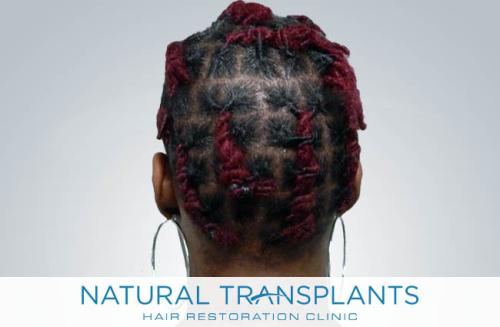 Undetectable Hair Transplant Scar