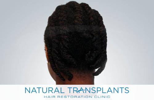 Undetectable Hair Transplant Scar