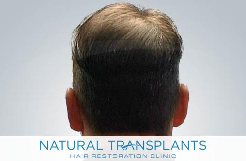 Undetectable Hair Transplant Scar