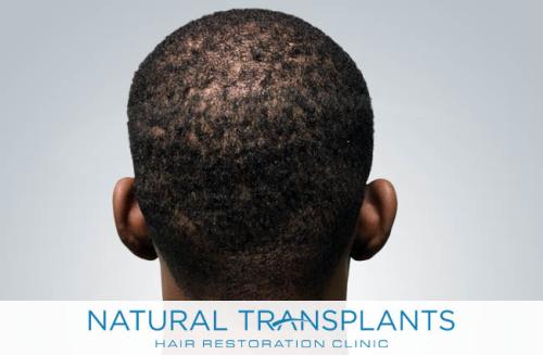 Undetectable Hair Transplant Scar