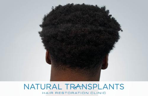 Undetectable Hair Transplant Scar