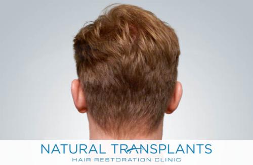 Undetectable Hair Transplant Scar