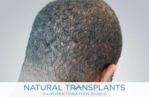 Undetectable Hair Transplant Scar