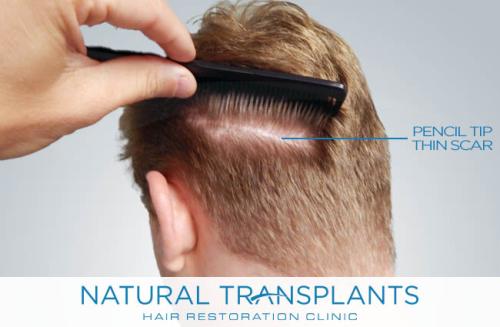 Undetectable Hair Transplant Scar