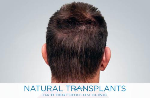 Undetectable Hair Transplant Scar