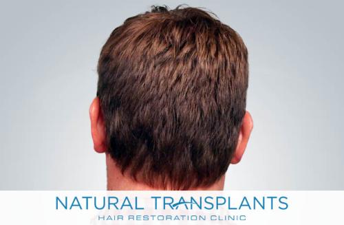 Undetectable Hair Transplant Scar