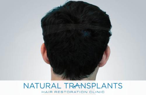 Undetectable Hair Transplant Scar