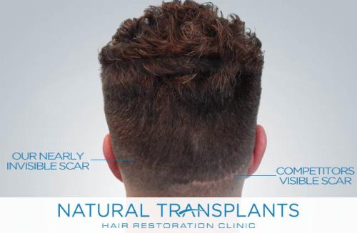 Undetectable Hair Transplant Scar