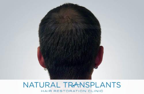 Undetectable Hair Transplant Scar